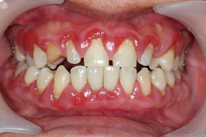 Lở miệng còn do ảnh hưởng từ các bệnh lý ở răng miệng