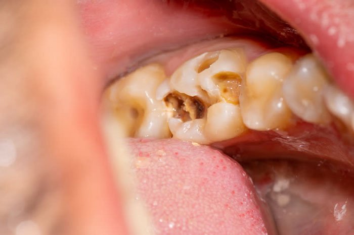 Răng sâu nặng sẽ dẫn đến viêm tủy