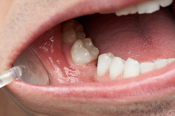 Mất răng 6 gây hiện tượng răng xô lệch