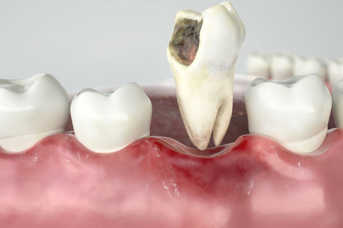 Nhổ chiếc răng mắc bệnh lý sẽ được hưởng bảo hiểm y tế