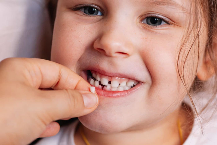 Nhổ răng sữa tại nhà khi chiếc răng lung lay nhiều và đã đến tuổi thay răng