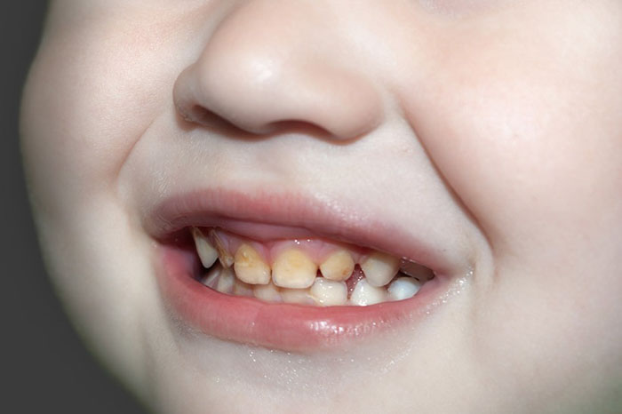 Răng bị vàng khiến nụ cười của trẻ trở nên kém xinh