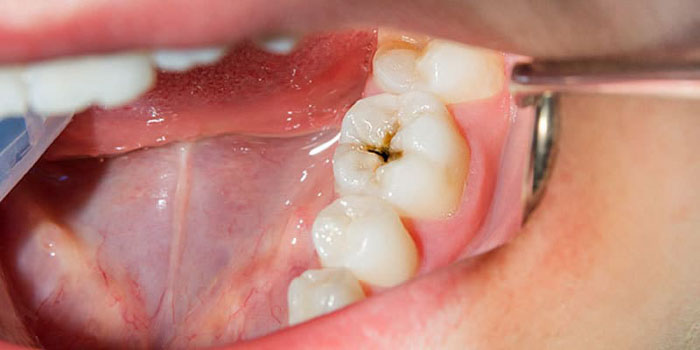 Răng hàm chỉ bị sâu nhẹ thì không phải nhổ