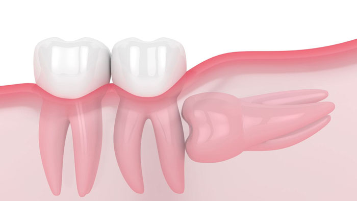 Răng khôn mọc ngầm mọc lệch là nguyên nhân hàng đầu gây đau nhức