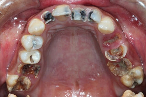 Sâu răng hàm không chữa trị hiệu quả vô cùng nguy hiểm