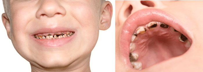 Sâu răng sẽ gây nhiều ảnh hưởng xấu cho trẻ nếu không điều trị sớm