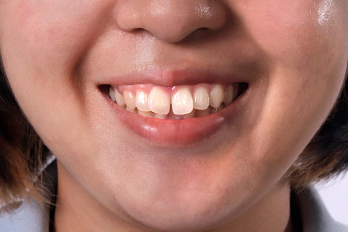 Sâu răng sữa làm tăng nguy cơ răng vĩnh viễn mọc khấp khểnh chen chúc