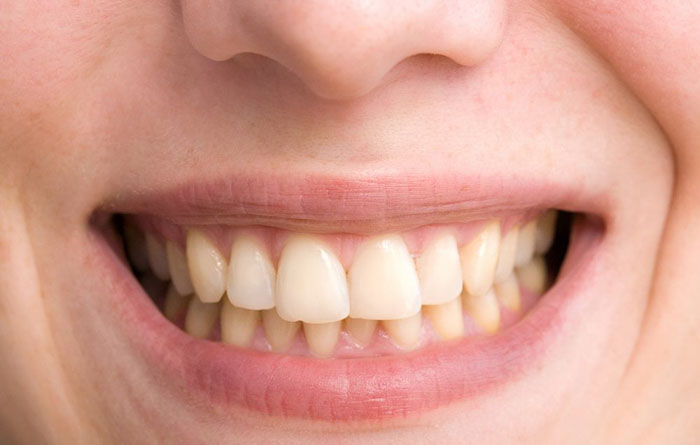 Răng ố vàng nên thực hiện tẩy trắng để cải thiện thẩm mỹ hiệu quả