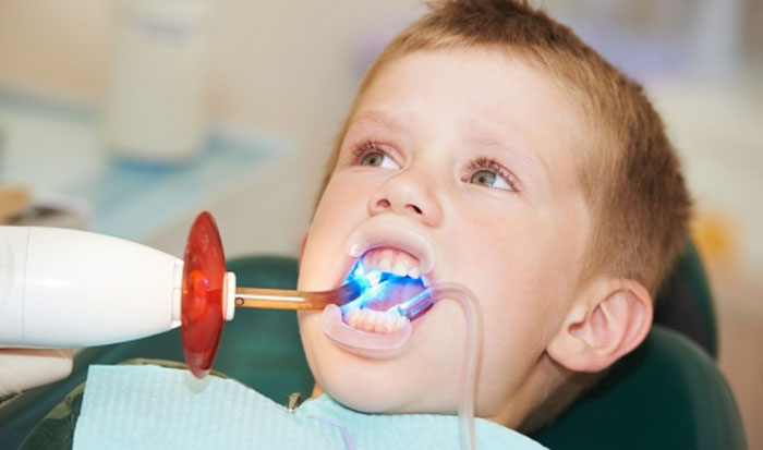 Trám răng nếu răng bé bị vàng do sâu răng
