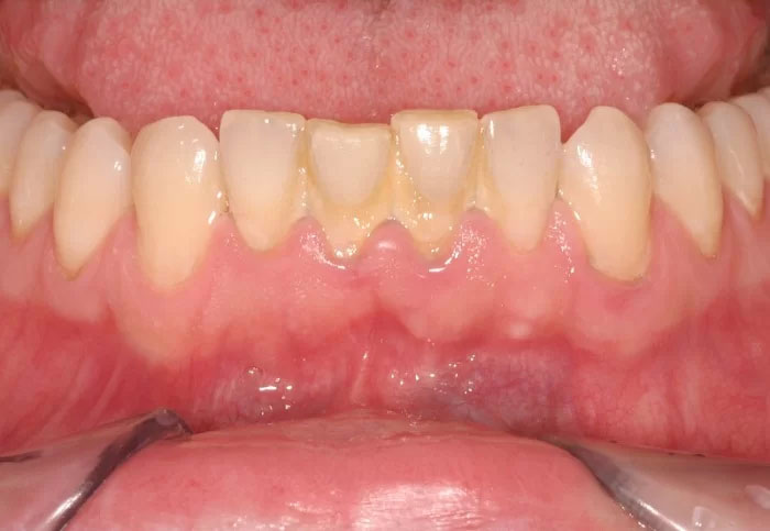 Vôi răng là nguyên nhân hàng đầu gây viêm lợi