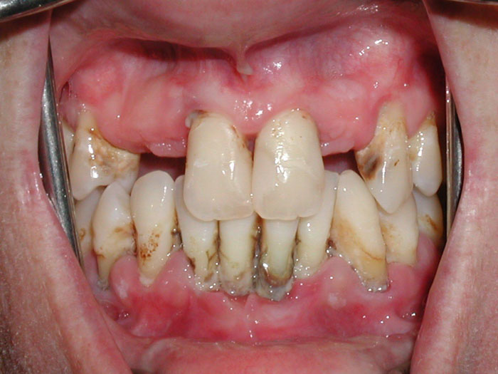 Các bệnh lý răng miệng cần phải được chữa trị dứt điểm