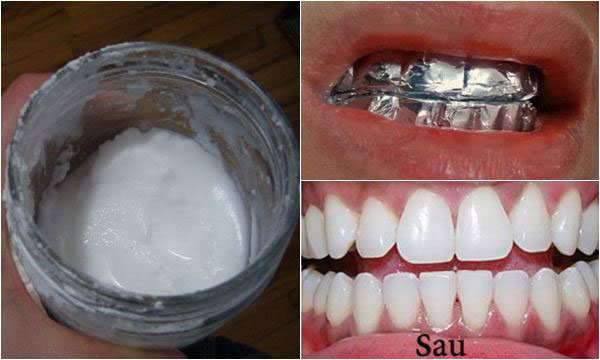 Cách làm trắng răng bằng Baking soda và giấy bạc