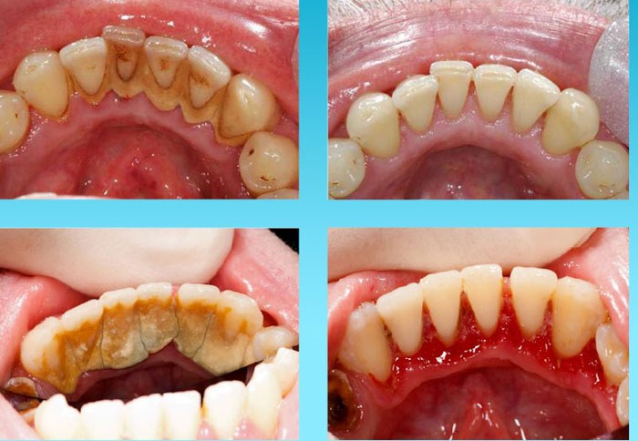 Cạo vôi răng loại bỏ nơi cư trú của vi khuẩn gây bệnh