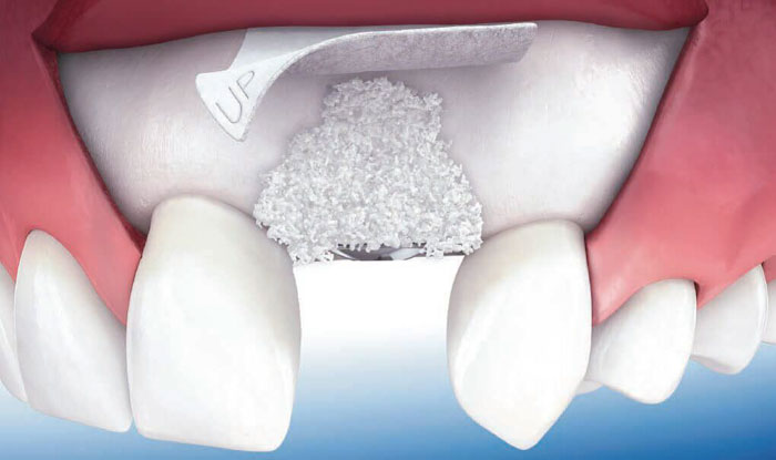 Cấy ghép màng xương khi thực hiện trồng răng Implant