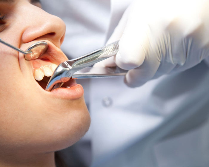 Chuyên môn và tay nghề của bác sĩ quyết định lớn đến tính an toàn của ca nhổ răng