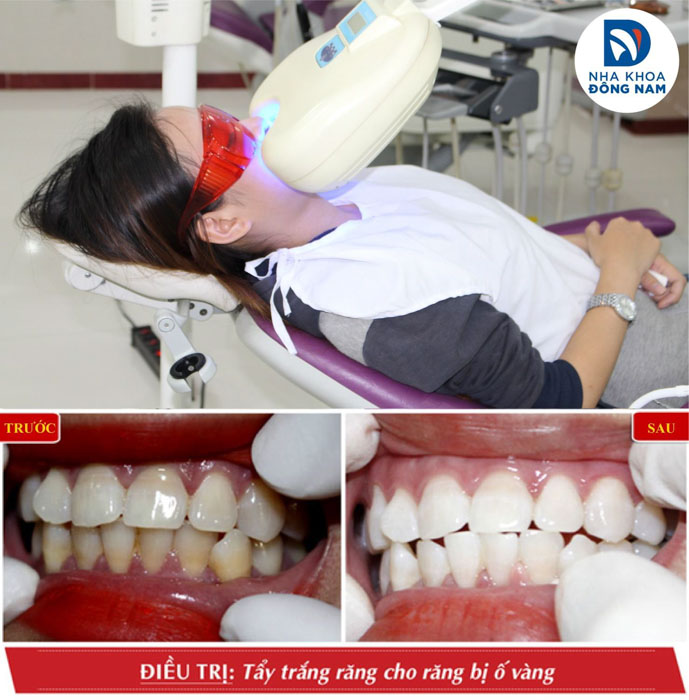 Có thể đến nha khoa để tẩy trắng răng an toàn, nhanh chóng hơn