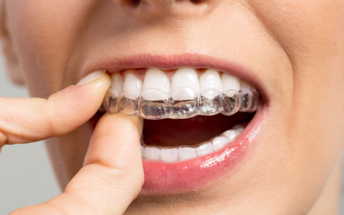 Đeo hàm duy trì sau khi kết thúc quá trình niềng răng