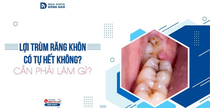 Lợi trùm răng khôn có tự hết không? Cần phải làm gì?