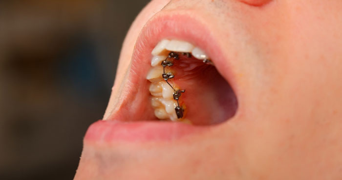 Mắc cài và dây cung được gắn vào mặt trong của thân răng