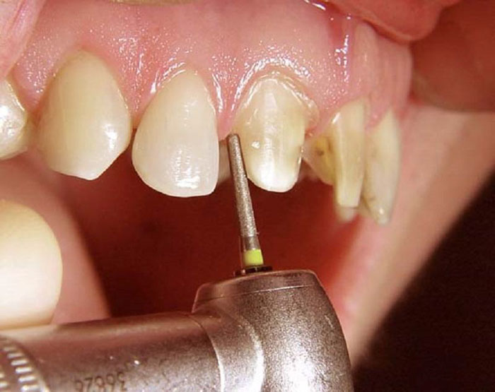 Mài răng đúng kỹ thuật sẽ không gây ảnh hưởng nguy hiểm