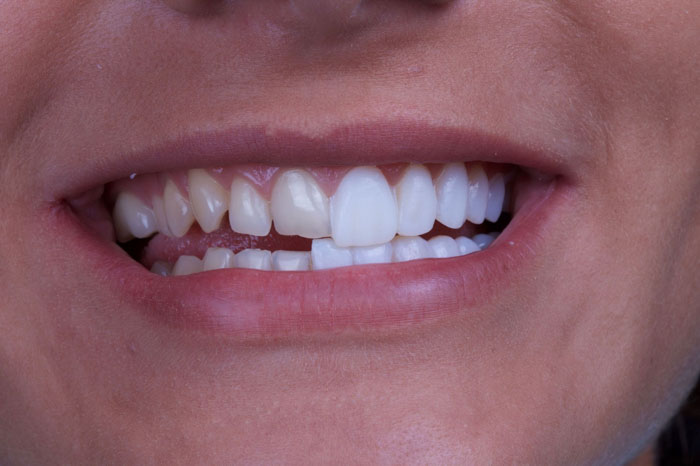 Mặt dán sứ chỉ cần mài một lớp mỏng mặt ngoài của răng giúp bảo tồn răng thật tối đa