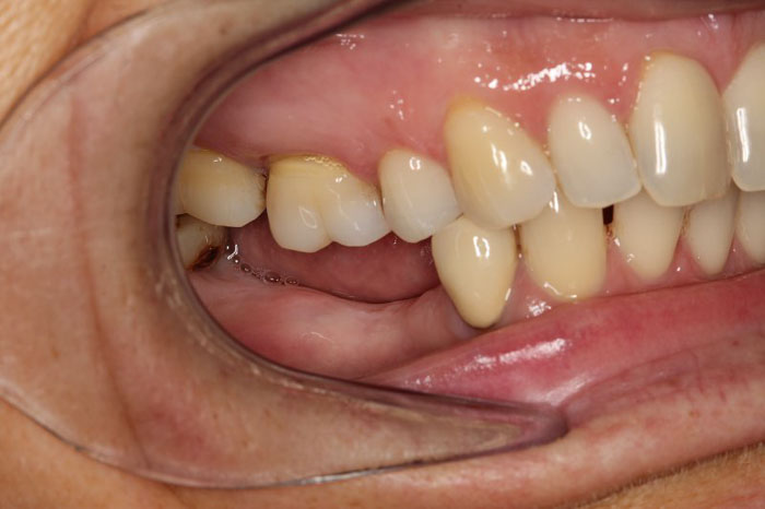 Mất răng là biến chứng nghiêm trọng của đau răng sưng má