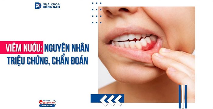 Nguyên nhân triệu chứng và phương pháp chẩn đoán viêm nướu răng