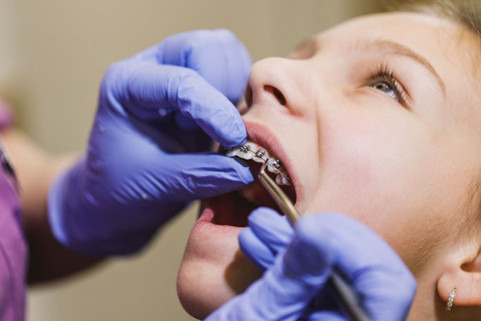 Nhổ răng khi niềng không gây ảnh hưởng xấu nào cho sức khỏe