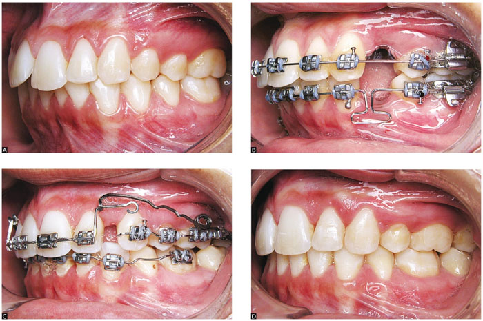 Nhổ răng tạo ra những khoảng trống giá trị giúp răng dịch chuyển trên cung hàm