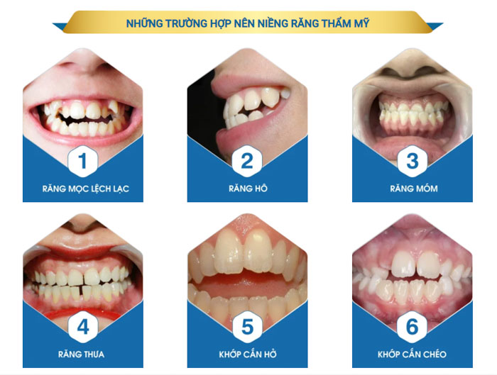 Niềng răng áp dụng được cho nhiều trường hợp sai lệch của răng