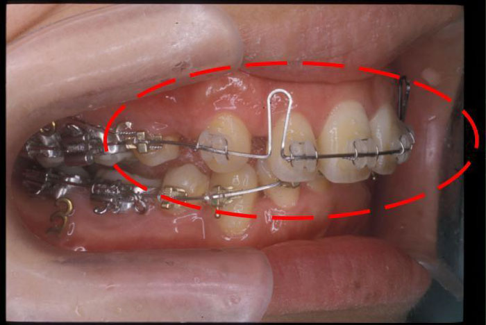 Niềng răng cần có khoảng trống phù hợp để răng dịch chuyển