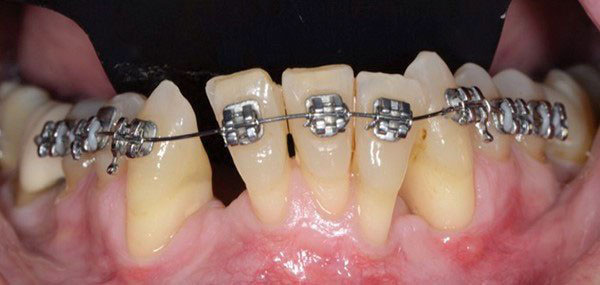 Niềng răng sai kỹ thuật gây nhiều hậu quả khó lường