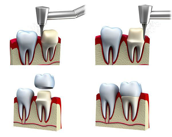 Răng bọc sứ sẽ được mài chỉnh với một tỷ lệ cho phép