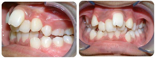 Răng có tình trạng sai lệch nặng cần nhổ răng để niềng hiệu quả