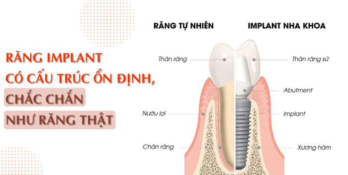 Răng Implant có cấu trúc tương tự răng thật, đảm bảo an toàn cao