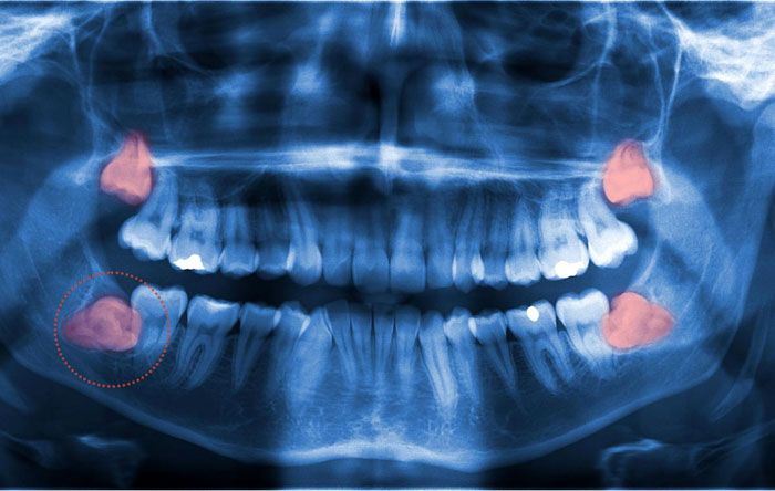Răng khôn mọc lệch mọc ngầm cần được chỉ định nhổ bỏ khi niềng răng