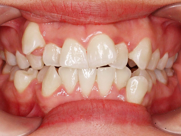 Răng mọc khấp khểnh thường sẽ nhổ răng khi niềng răng