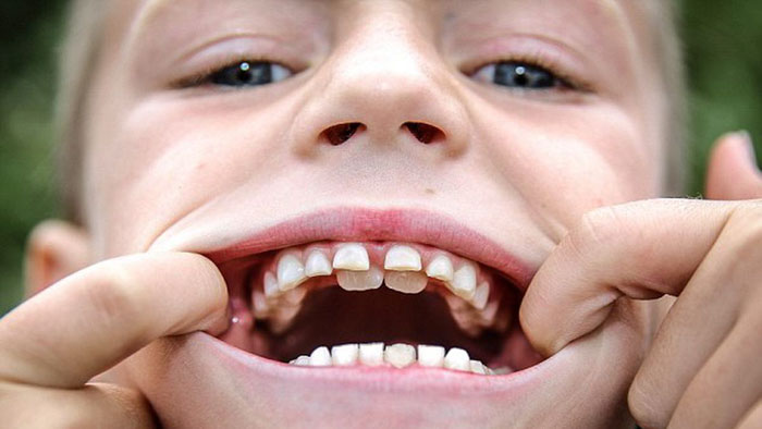 Răng mọc sai lệch khiến hàm răng của trẻ trông kém thẩm mỹ
