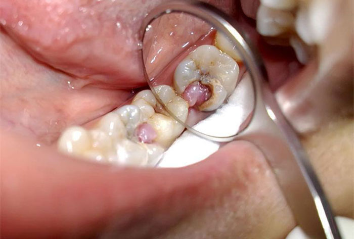 Răng sâu bị lồi thịt là một dạng viêm nhiễm, áp xe răng