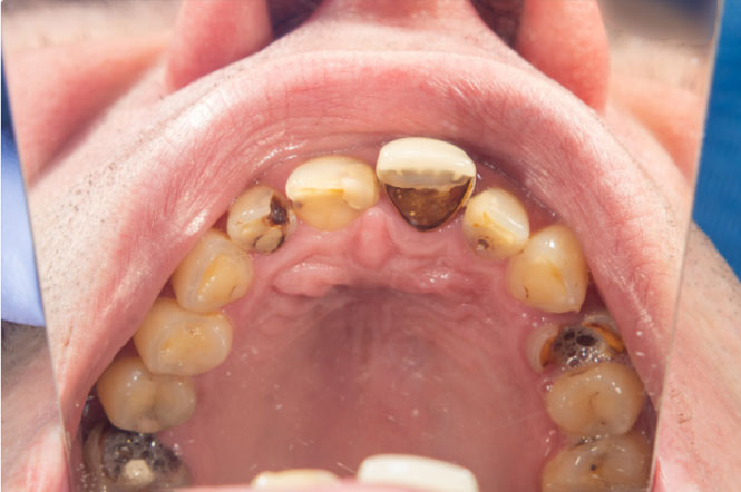 Răng sâu hỏng nghiêm trọng nên nhổ bỏ sớm