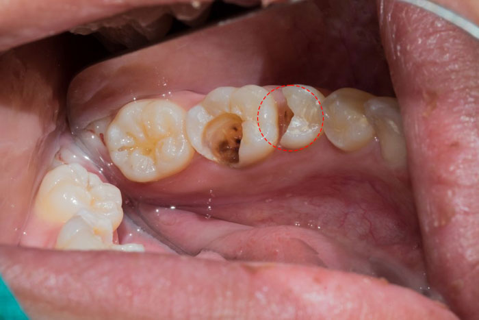 Răng số 5 bị sứt mẻ lớn và chân răng lung lay