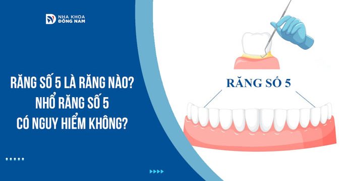 Răng số 5 là răng nào? Nhổ răng số 5 có nguy hiểm không?