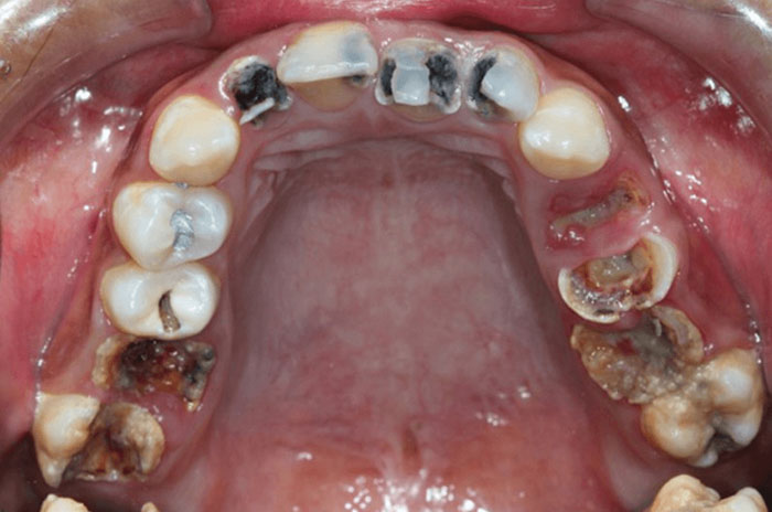 Sâu răng nặng có thể gây mất răng vĩnh viễn
