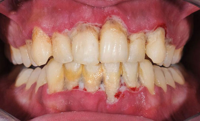 Sưng chân răng có thể do viêm nướu, viêm nha chu gây nên