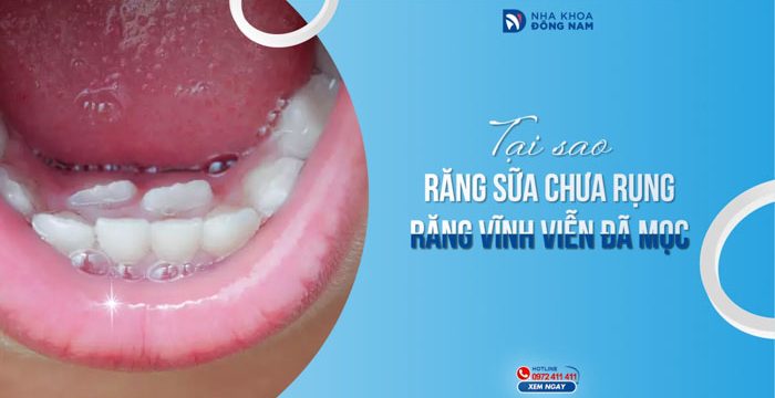 Tại sao răng sữa chưa rụng răng vĩnh viễn đã mọc?