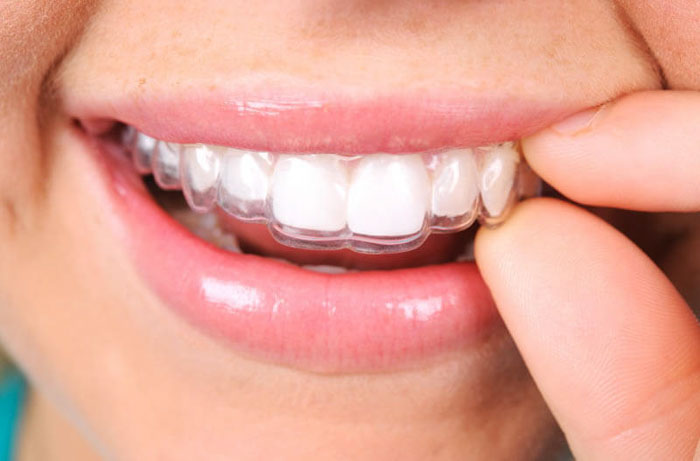 Thẩm mỹ cao là ưu điểm nổi bật của phương pháp niềng răng tháo lắp
