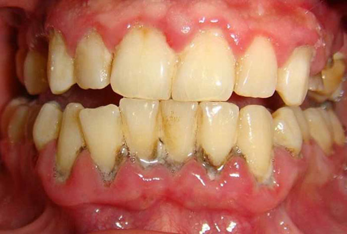 Thời gian bọc sứ cho răng có bệnh lý sẽ lâu hơn bình thường