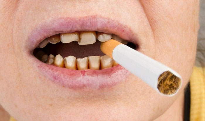 Thói quen hút thuốc rất có hại cho sức khỏe răng miệng