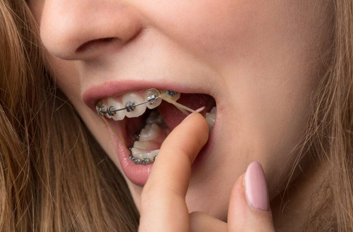 Thun liên hàm là khí cụ được dùng phổ biến trong niềng răng chỉnh nha