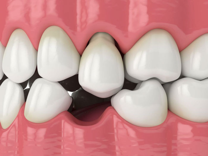Tiêu xương hàm làm tăng nguy cơ mất thêm răng